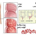 درمان کولیت و عفونت و التهاب روده با ازن یا اکسیژن فعال
